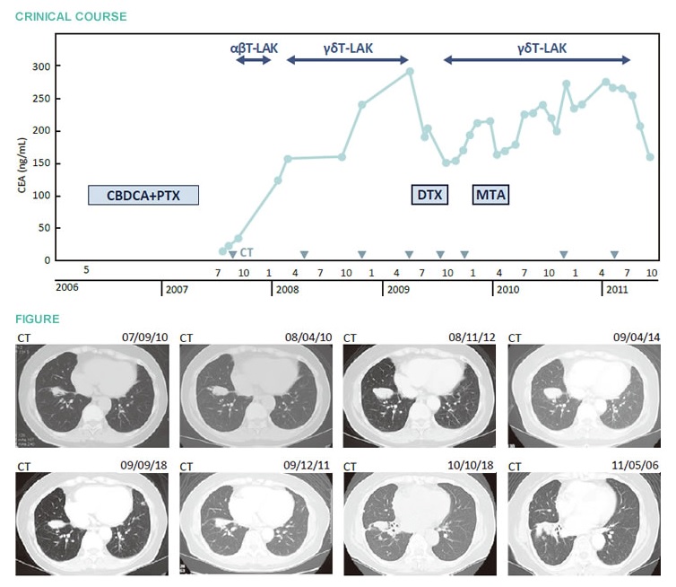 αβT細(xì)胞治療抑制腫瘤進(jìn)展，γδT細(xì)胞治療維持長期穩(wěn)定的肺腺癌案例